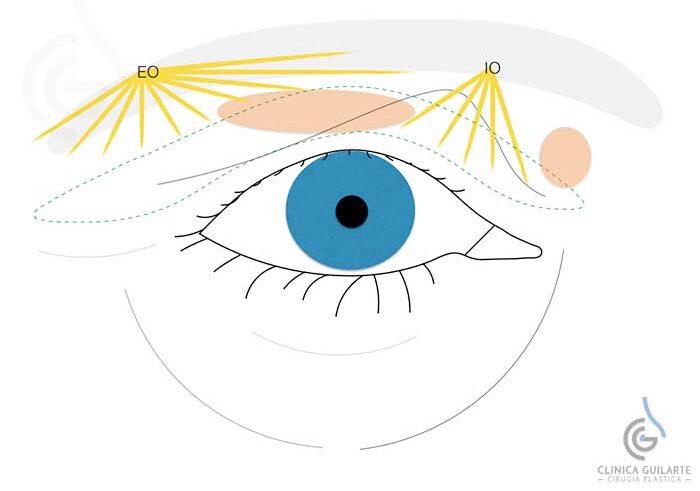 Blefaroplastia superior+ Lipofilling Blefaroplastia superior+ Lipofilling
