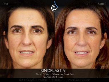 Rinoplastia HIGH STRIP