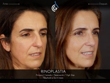 Rinoplastia HIGH STRIP