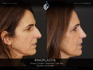 Rinoplastia HIGH STRIP