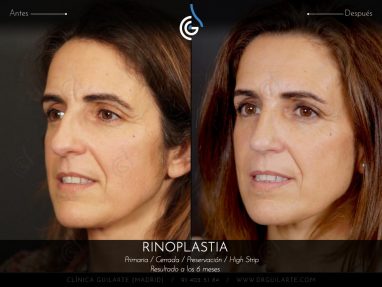 Rinoplastia HIGH STRIP