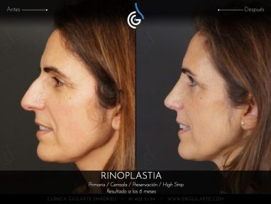Rinoplastia HIGH STRIP