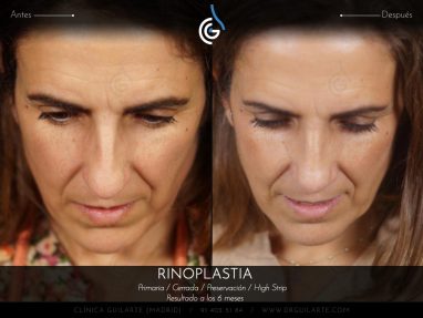 Rinoplastia HIGH STRIP