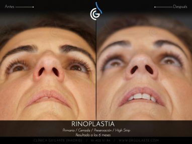 Rinoplastia HIGH STRIP