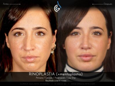 Rinoplastia LOW STRIP + Mentoplastia » Secuencia de fotografias completa, resultado paciente del Dr.Rubén Guilarte