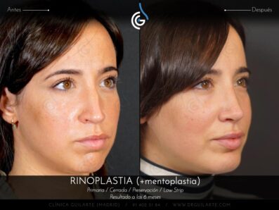 Rinoplastia LOW STRIP + Mentoplastia » Secuencia de fotografias completa, resultado paciente del Dr.Rubén Guilarte