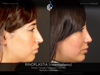 Rinoplastia LOW STRIP + Mentoplastia » Secuencia de fotografias completa, resultado paciente del Dr.Rubén Guilarte