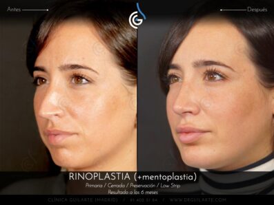 Rinoplastia LOW STRIP + Mentoplastia » Secuencia de fotografias completa, resultado paciente del Dr.Rubén Guilarte