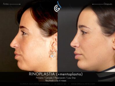 Rinoplastia LOW STRIP + Mentoplastia » Secuencia de fotografias completa, resultado paciente del Dr.Rubén Guilarte