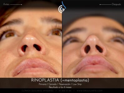 Rinoplastia LOW STRIP + Mentoplastia » Secuencia de fotografias completa, resultado paciente del Dr.Rubén Guilarte