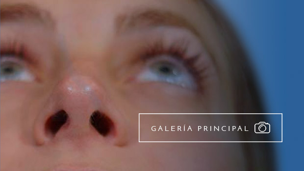 Rinoplastia ultrasonica, de preservación o cerrada... los mejores resultados de Rinoplastia en España Rinoplastia ultrasonica, de preservación o cerrada... los mejores resultados de Rinoplastia en España