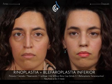 Blefaroplastia: cirugía párpados eliminación bolsas inferiores junto Rinoplastia el resultado es rejuvenecimiento total del rostro (autor Dr. Guilarte)
