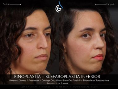 Blefaroplastia: cirugía párpados eliminación bolsas inferiores junto Rinoplastia el resultado es rejuvenecimiento total del rostro (autor Dr. Guilarte)