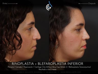 Blefaroplastia: cirugía párpados eliminación bolsas inferiores junto Rinoplastia el resultado es rejuvenecimiento total del rostro (autor Dr. Guilarte)