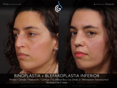 Blefaroplastia: cirugía párpados eliminación bolsas inferiores junto Rinoplastia el resultado es rejuvenecimiento total del rostro (autor Dr. Guilarte)