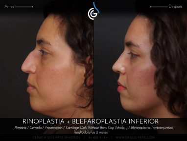 Blefaroplastia: cirugía párpados eliminación bolsas inferiores junto Rinoplastia el resultado es rejuvenecimiento total del rostro (autor Dr. Guilarte)