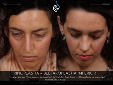 Blefaroplastia: cirugía párpados eliminación bolsas inferiores junto Rinoplastia el resultado es rejuvenecimiento total del rostro (autor Dr. Guilarte)