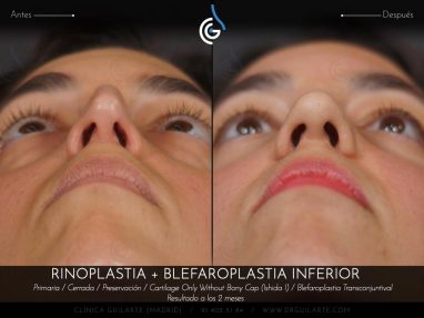 Blefaroplastia: cirugía párpados eliminación bolsas inferiores junto Rinoplastia el resultado es rejuvenecimiento total del rostro (autor Dr. Guilarte)