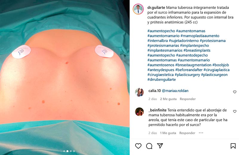 Resultado mama tuberosa operada por el Dr. Guilarte (foto instagram)
