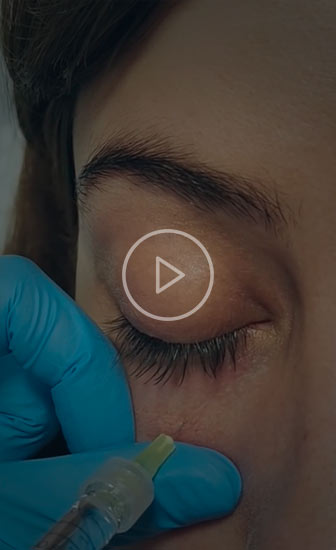Acido hialurónico para tratar las ojeras