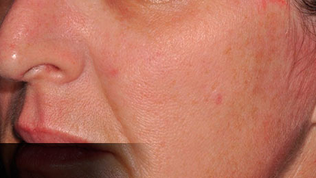 ANTES Tratamientos Láser » Resurfacing » Antes