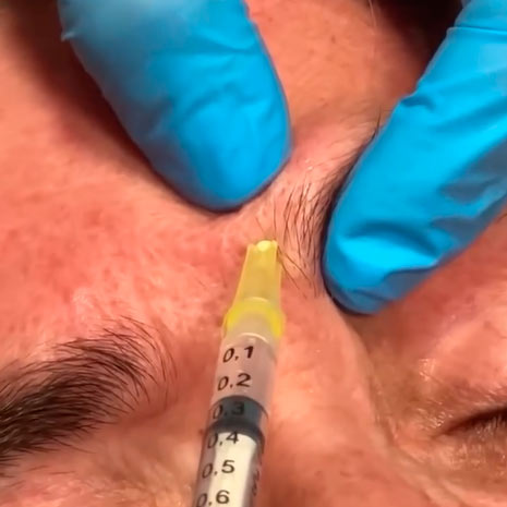 Tecnica combinada - Láser y Botox 2de2
