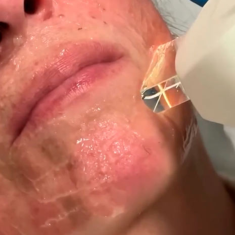 Tecnica combinada - Láser y Botox 1de2