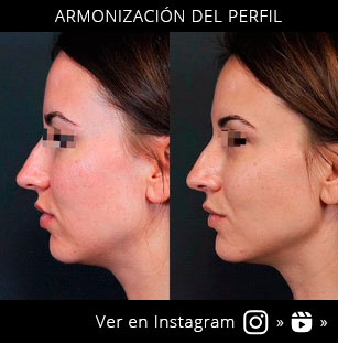 acido-hialuronico-armonizacion-del-perfil
