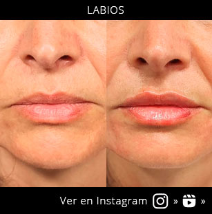 acido-hialuronico-labios-1