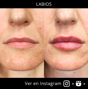 acido-hialuronico-labios-22