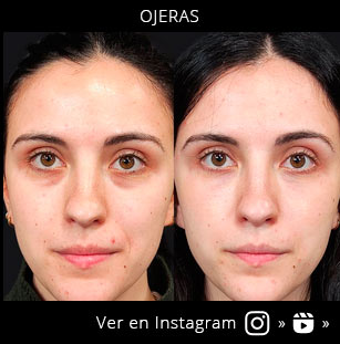 acido-hialuronico-ojeras