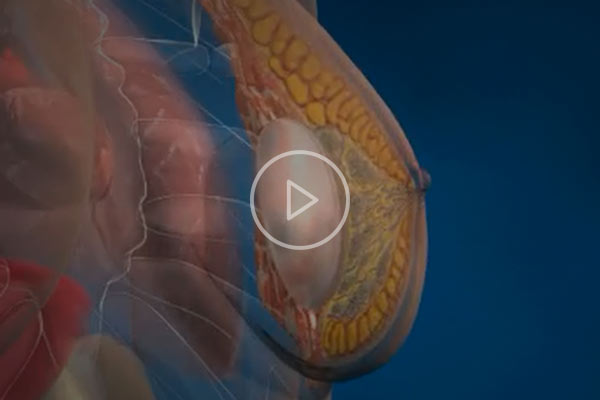 Aumento de pecho: vídeo didáctico: tipos de implantes y funciones Aumento de pecho: vídeo didáctico: tipos de implantes y funciones