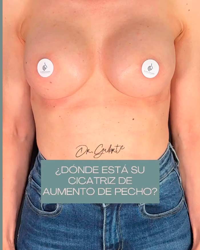 donde esta la cicatirz del aumento de pecho 2de2 donde esta la cicatirz del aumento de pecho 2de2