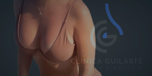 Luciendo un bonito escote años despues de la operación Luciendo un bonito escote años despues de la operación