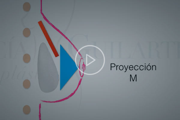 Vídeo Proyección del implante Vídeo Proyección del implante