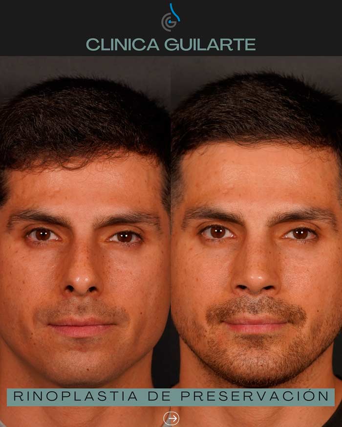 Rinoplastia de preservacion con ultrasonidos y mentoplastia. Cirujano plástico Dr. Guilarte. Imagen antes y después de la cirugía