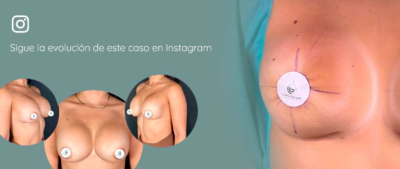 Caso Instagram de recambio de prótesis