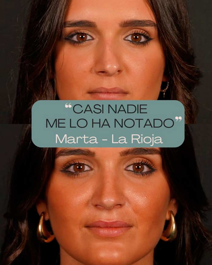 Rinoplastia ultrasonica con factura septal - Casi nadie me lo ha notado
