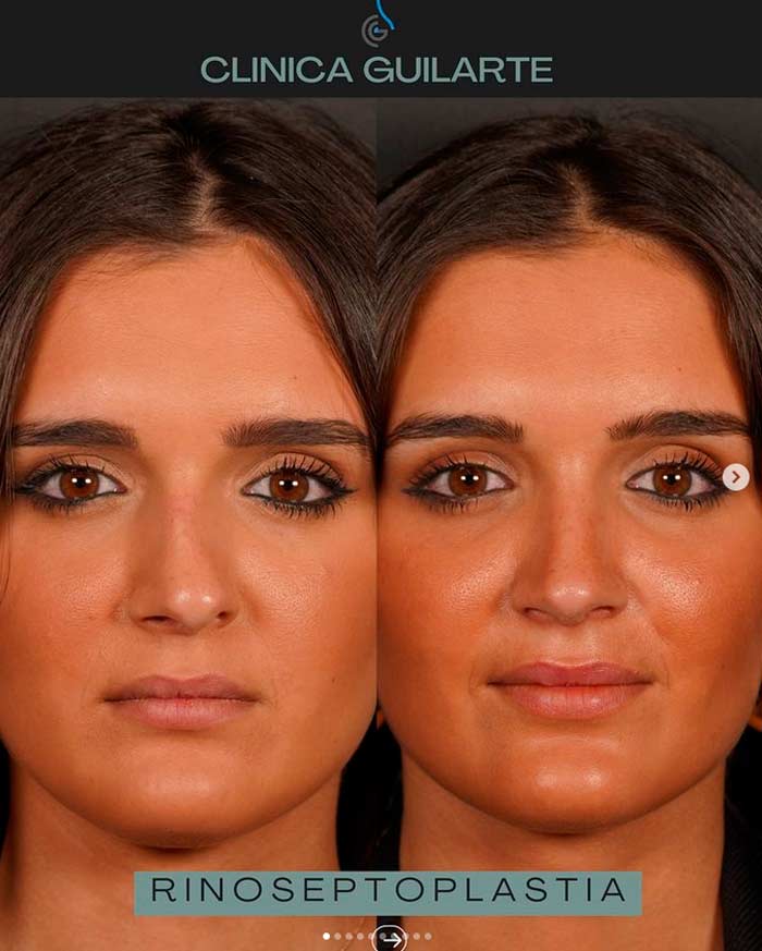 Rinoplastia ultrasonica con factura septal