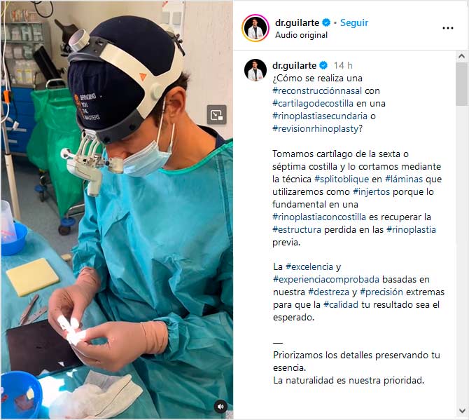 Preparando una rinoplastia secundaria con injerto costilla técnica splitoblique