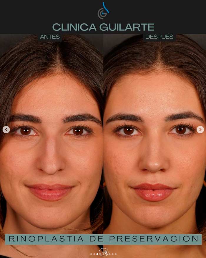 Rinoplastia primaria de preservación