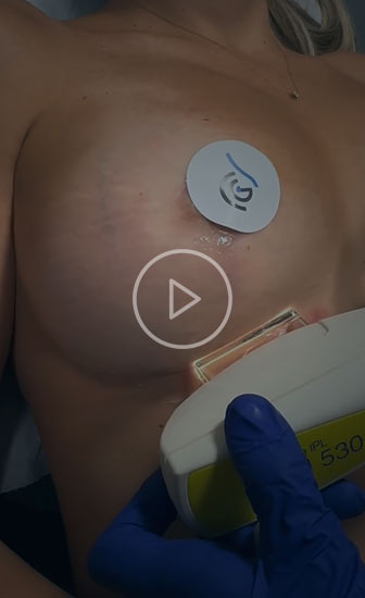 Uso del láser para tratar las cicatrices de una mastopexia en la Clínica Guilarte Uso del láser para tratar las cicatrices de una mastopexia en la Clínica Guilarte