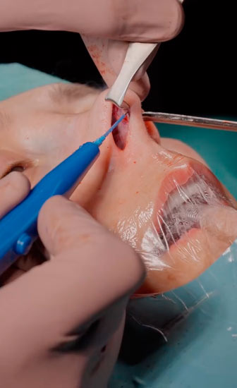 Posoperatorio de una rinoplastia
