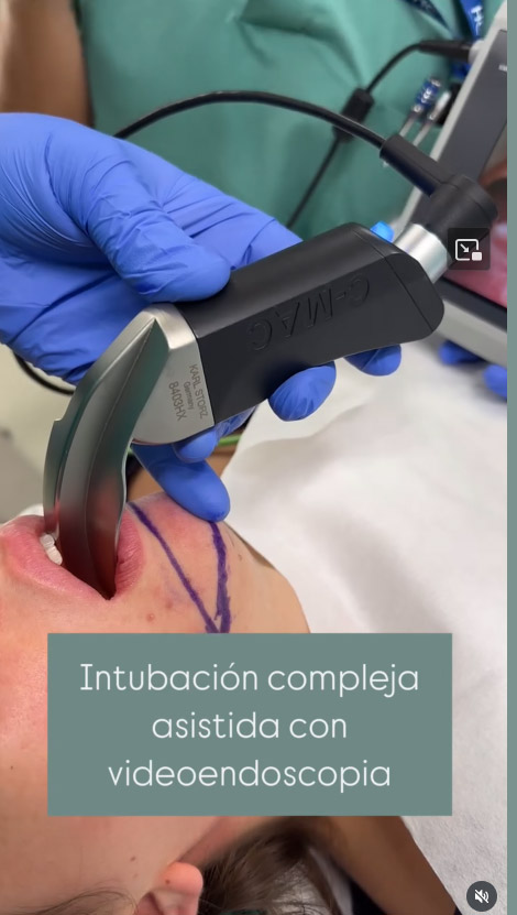 Anestesia en la Clínica Guilarte: intubacion compleja asistida con videoendoscopia 1de2
