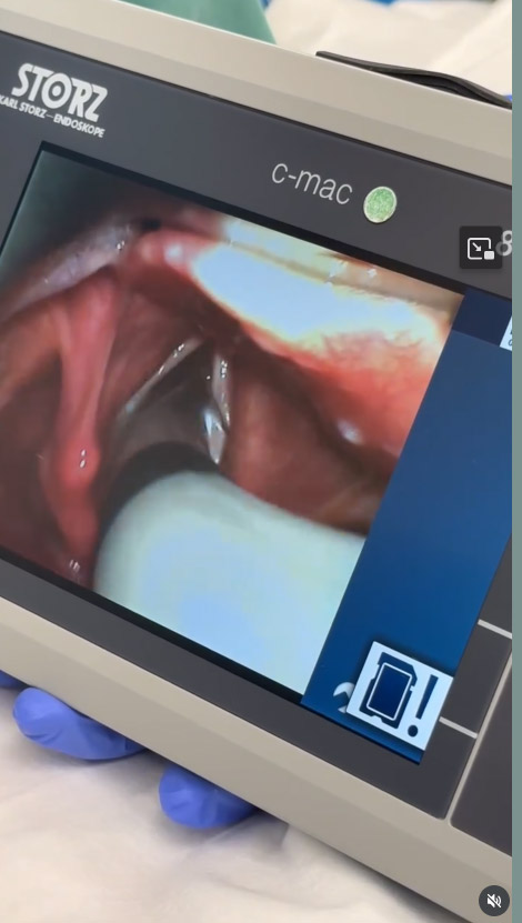 Anestesia en la Clínica Guilarte: intubacion compleja asistida con videoendoscopia 2de2