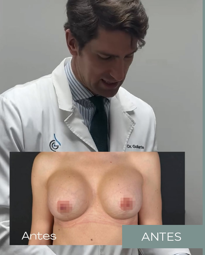 Contractura capsular > Antes Contractura capsular > Antes