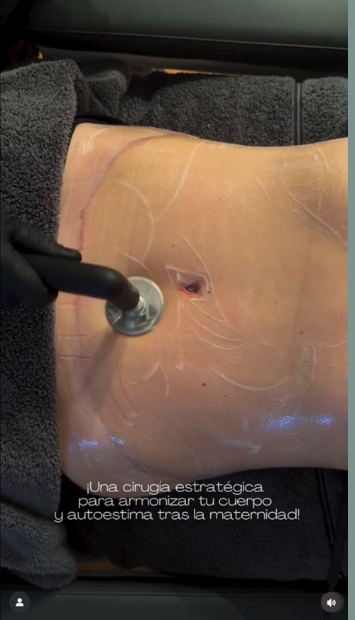 Indiba corporal después de una abdominoplastia. Cómo se hace y cuál es el resultado - Clinica Guilarte - 1 de 2 Indiba corporal después de una abdominoplastia. Cómo se hace y cuál es el resultado - Clinica Guilarte - 1 de 2