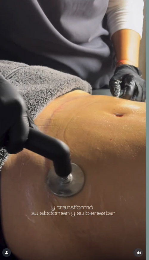 Indiba corporal después de una abdominoplastia. Cómo se hace y cuál es el resultado - Clinica Guilarte - 2 de 2 Indiba corporal después de una abdominoplastia. Cómo se hace y cuál es el resultado - Clinica Guilarte - 2 de 2