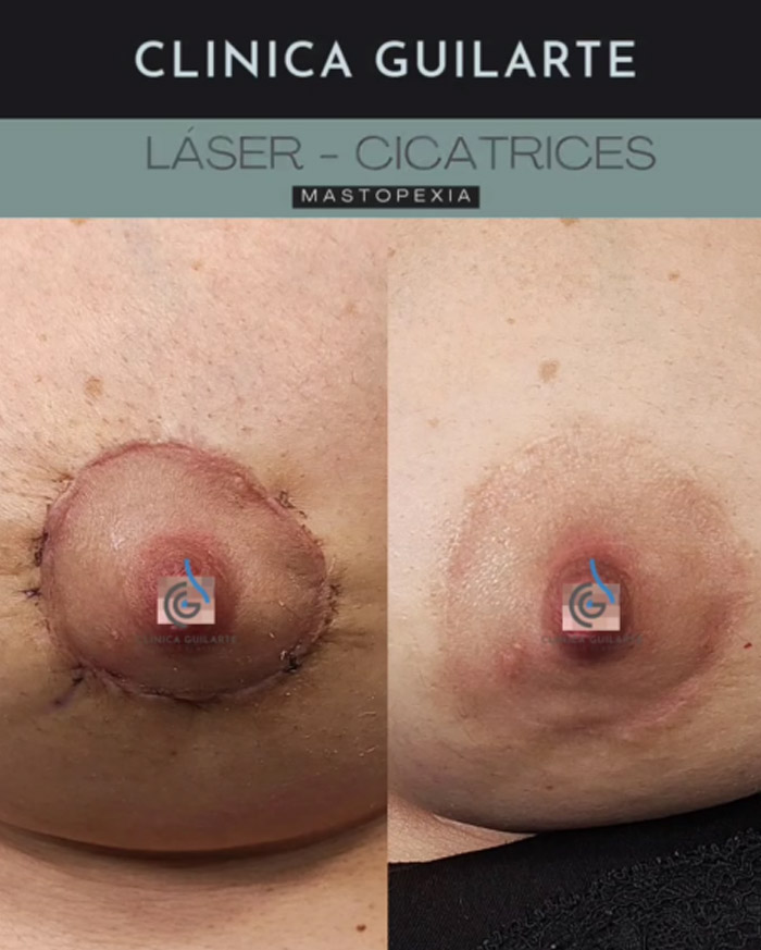 Laser para cicatrices del pecho despues de una mastopexia Laser para cicatrices del pecho despues de una mastopexia