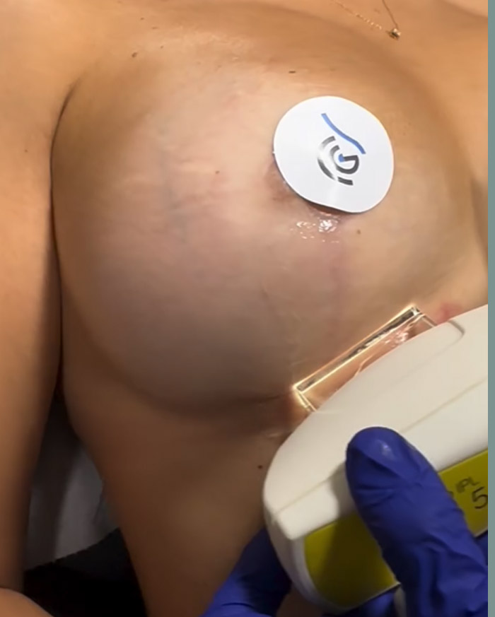 Laser para cicatrices del pecho despues de una mastopexia Laser para cicatrices del pecho despues de una mastopexia